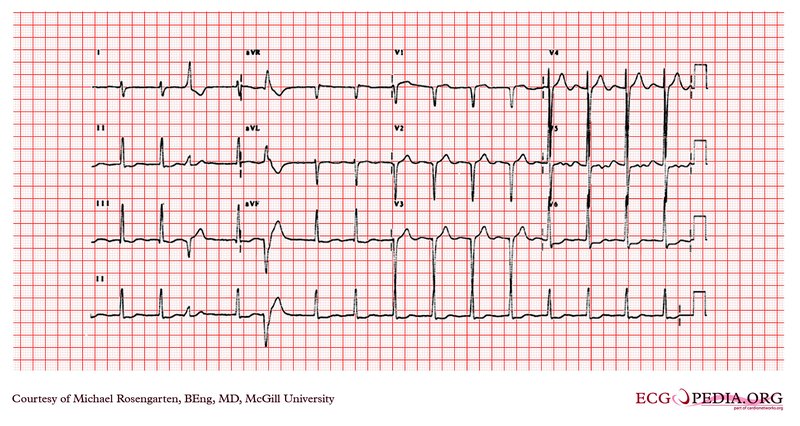 Stimulateur cardiaque (pacemaker) : types, pose, suivi