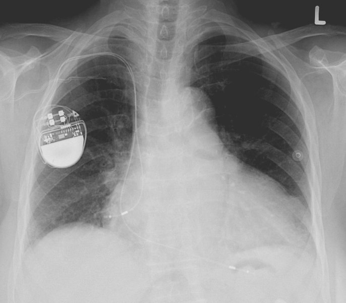 Bradycardie mal tolérée : prise en charge en urgence