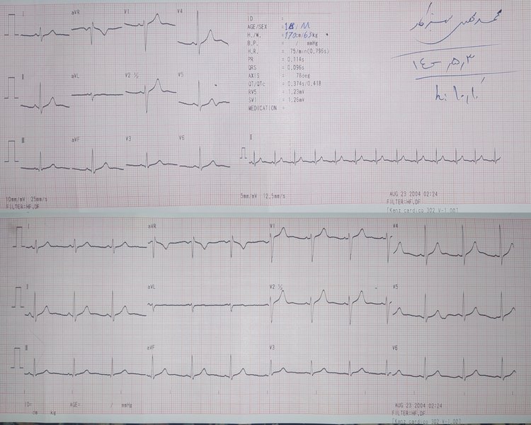 Palpitations : définition, diagnostic, exploration