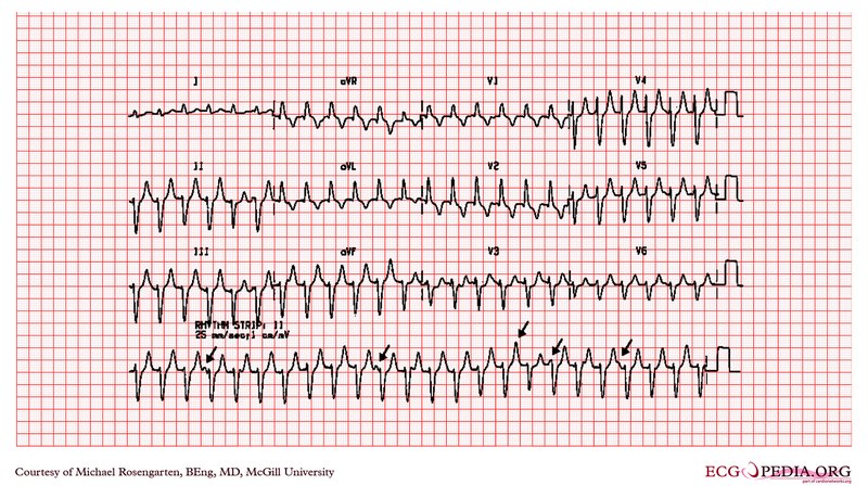 Palpitations : définition, diagnostic, exploration
