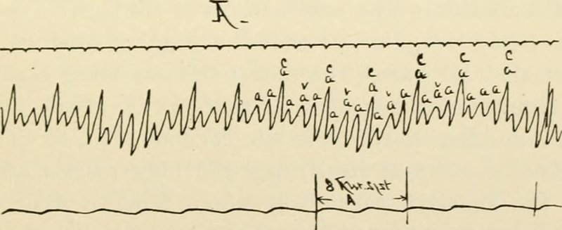 Flutter auriculaire