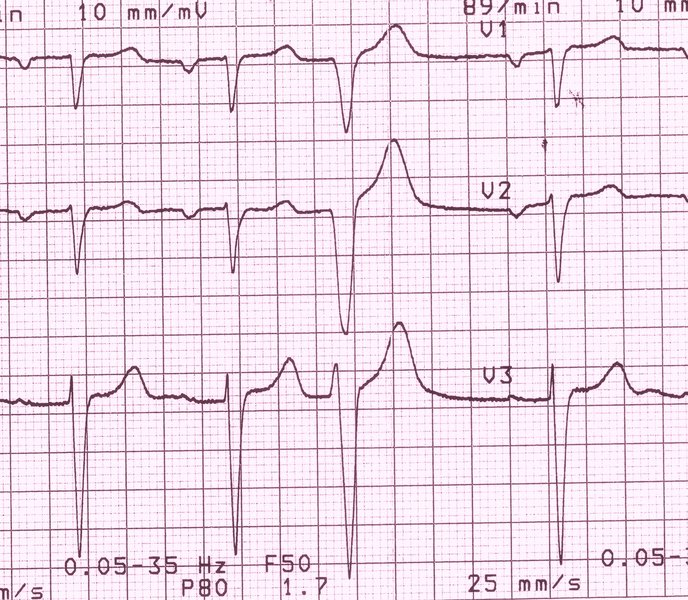 Extrasystole ventriculaire (ESV)