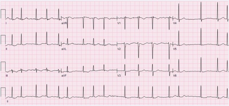 Fibrillation ventriculaire (FV)
