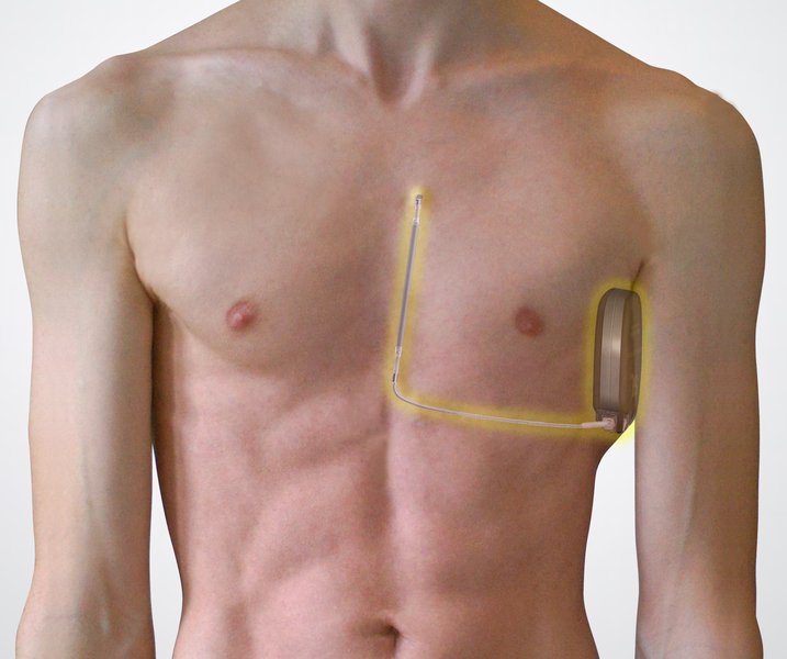Défibrillateur automatique implantable (DAI)