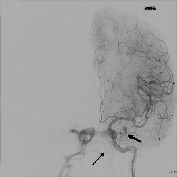 Traumatisme vasculaire cervical (fermé/ouvert)