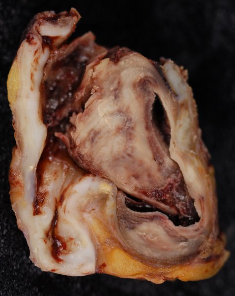 Traumatisme vasculaire cervical (fermé/ouvert)