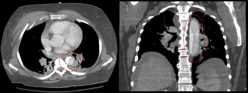 Rupture isthmique de l'aorte thoracique