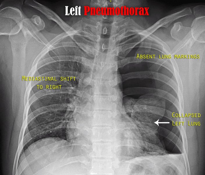 Rupture isthmique de l'aorte thoracique