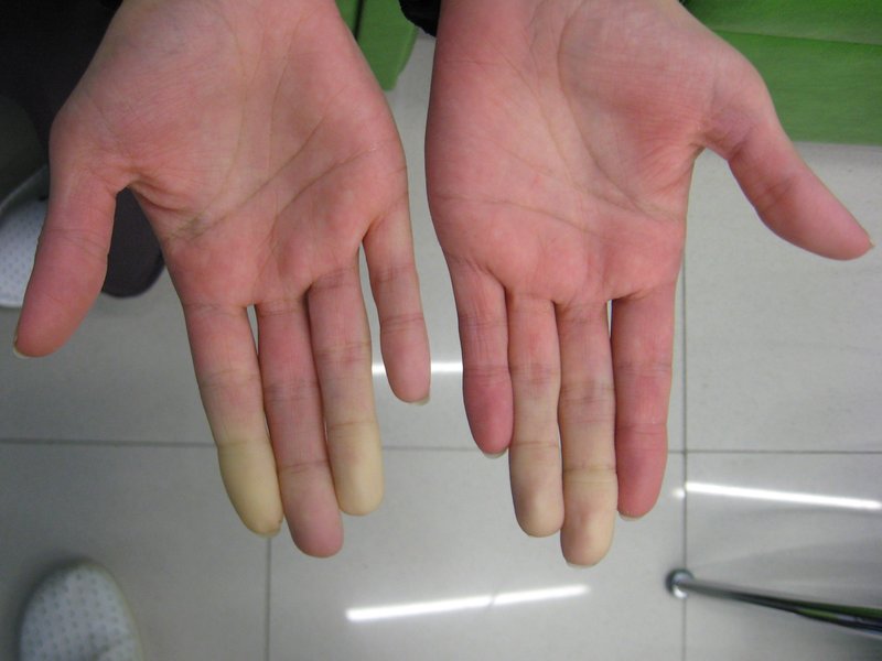 Traumatisme vasculaire d'un membre