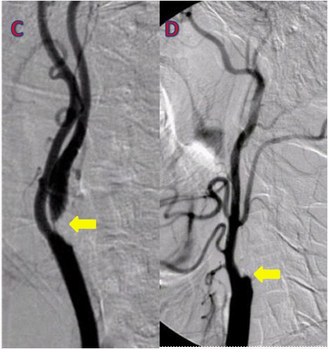 Traumatisme vasculaire d'un membre