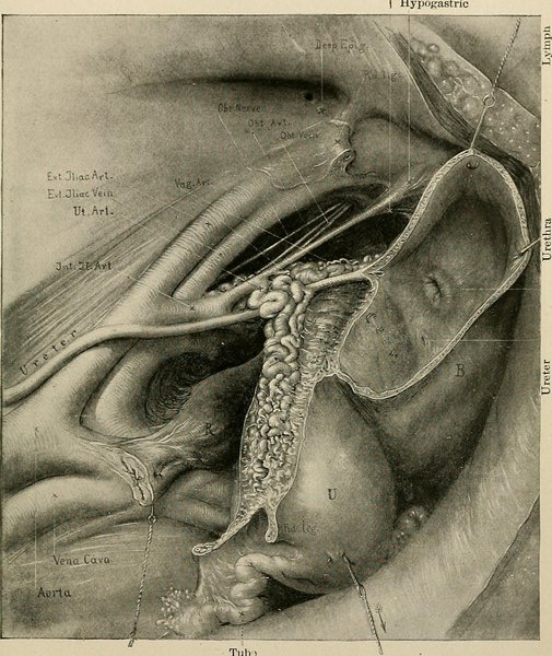 Traumatisme vasculaire abdominal