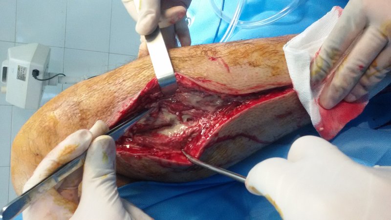Traumatisme vasculaire abdominal
