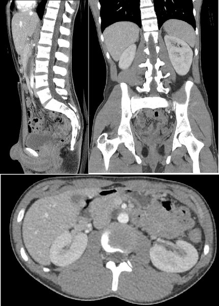 Traumatisme vasculaire abdominal
