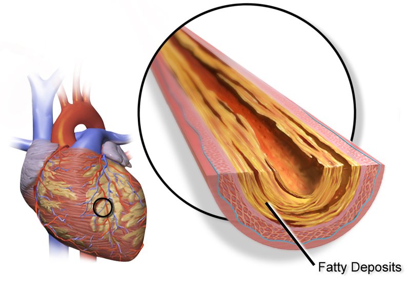Physiopathologie du SCA