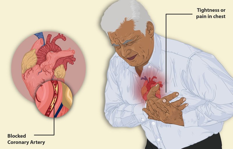 SCA ST- : diagnostic (douleur, ECG, troponine)