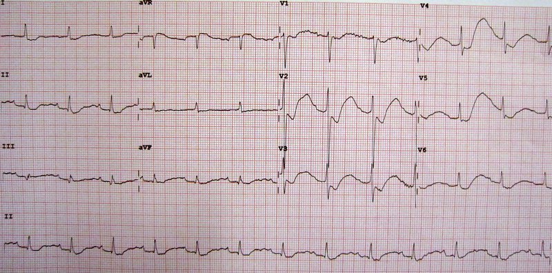 SCA ST- : diagnostic (douleur, ECG, troponine)