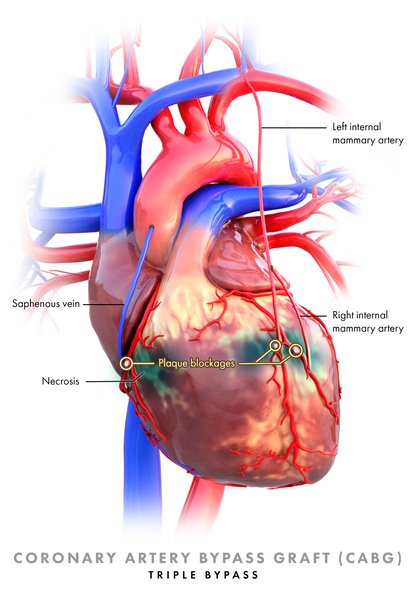 Revascularisation myocardique dans le SCA ST-