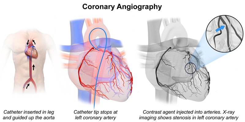 Revascularisation myocardique dans le SCA ST-