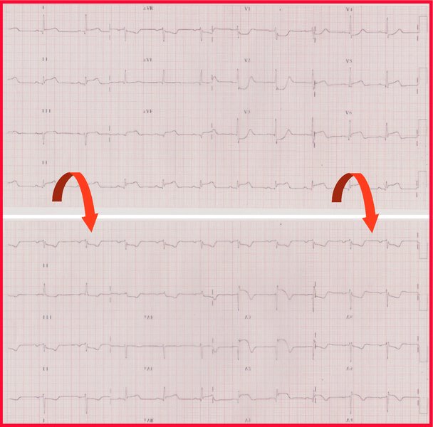 SCA ST+ : diagnostic ECG (chronologie, localisation, miroir)