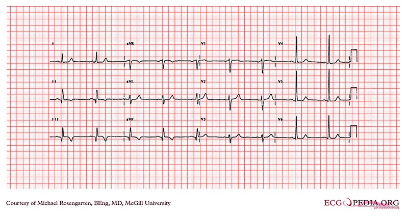 SCA ST+ : diagnostic ECG (chronologie, localisation, miroir)
