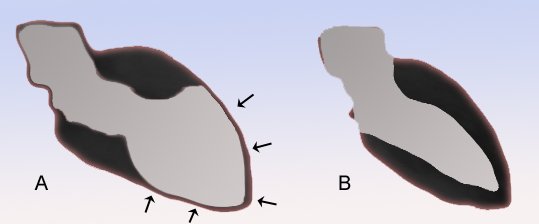 Myocardite aiguë / Syndrome de Tako-Tsubo
