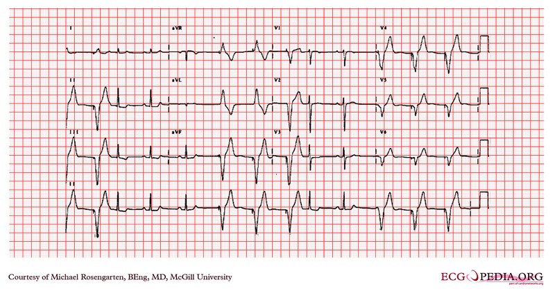 IDM du ventricule droit