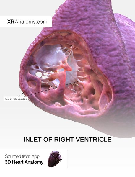 IDM du ventricule droit