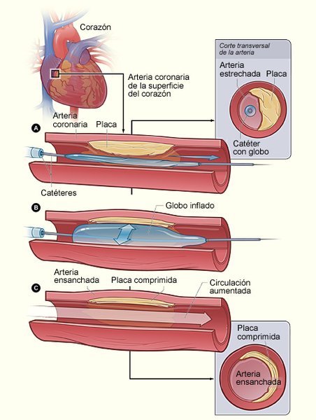 Angioplastie primaire dans le SCA ST+