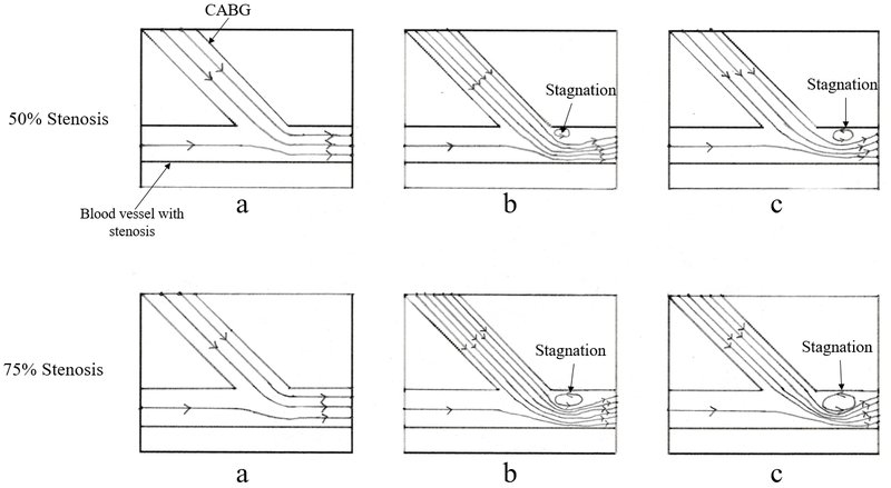 Physiopathologie et diagnostic de l'angor stable