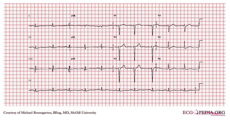 ECG d'effort : indications et critères