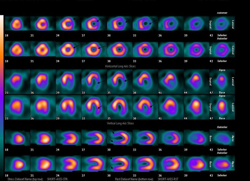 Scintigraphie myocardique et écho de stress