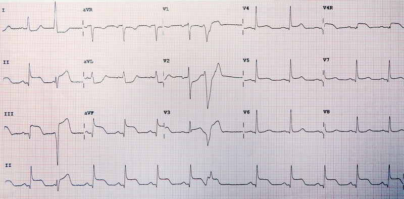Traitement médicamenteux de l'angor stable