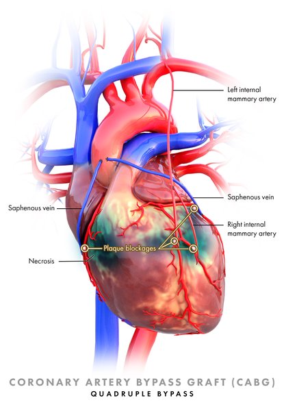 Revascularisation coronarienne (angioplastie, pontage PAC)