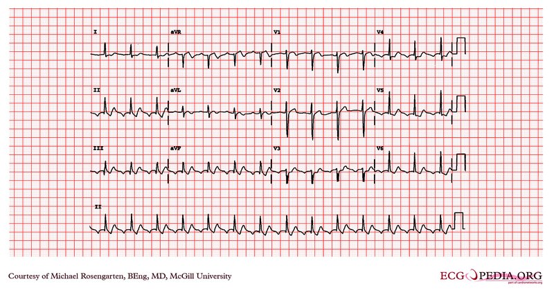 Définitions : Malaise, PDCB, Syncope, Lipothymie