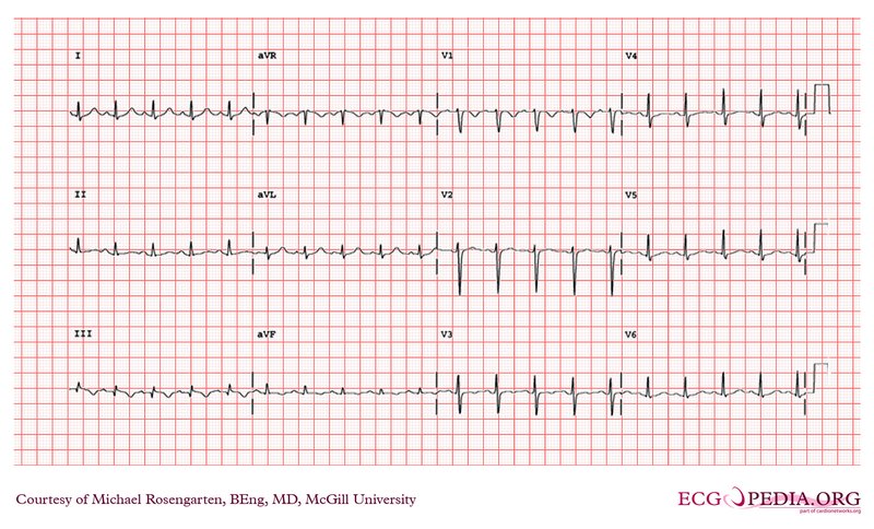 Diagnostic et critères de gravité de la syncope