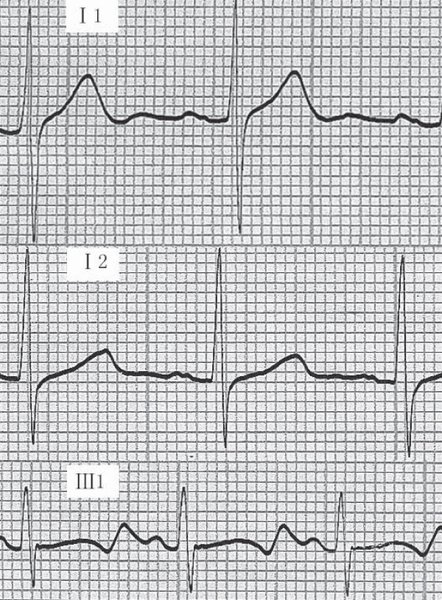 Diagnostic et critères de gravité de la syncope