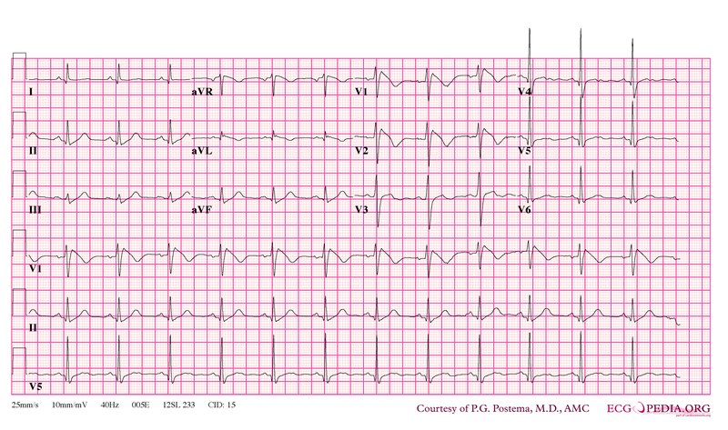 ECG dans la syncope : diagnostic et orientation