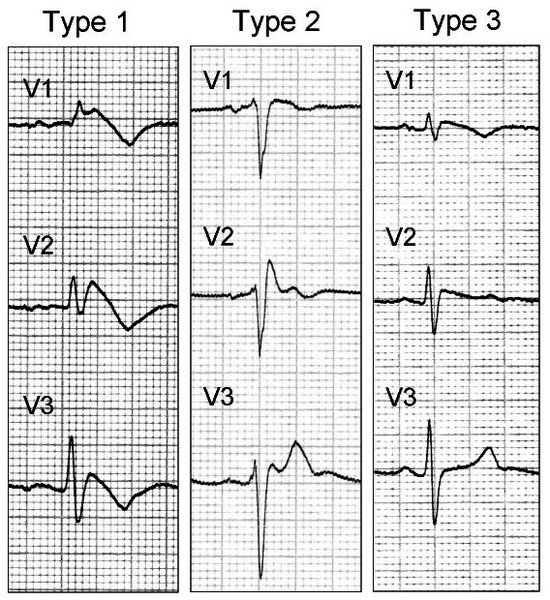 ECG dans la syncope : diagnostic et orientation