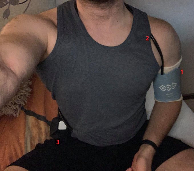 Bilan de la syncope : ETT, Holter, test d'effort