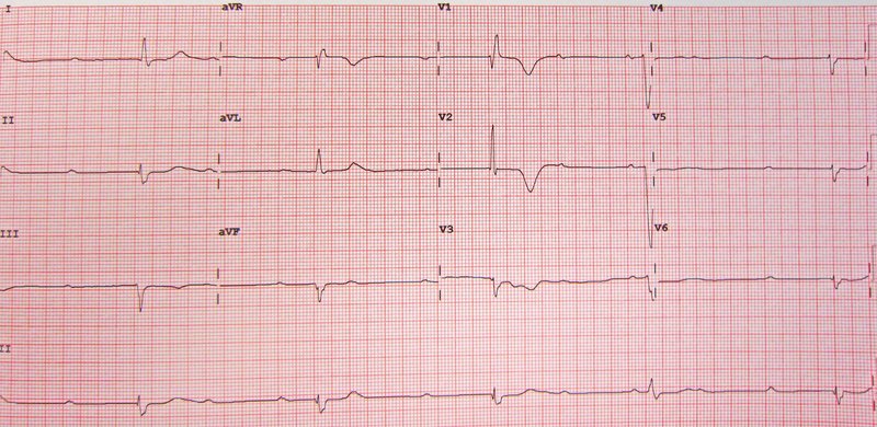 Syncope d'origine cardiaque (Adams-Stokes)