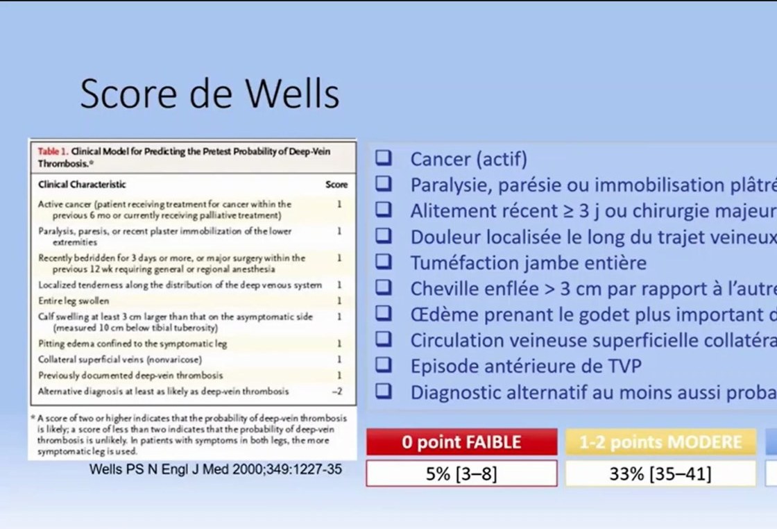 Thrombose Veineuse Profonde et Embolie Pulmonaire
