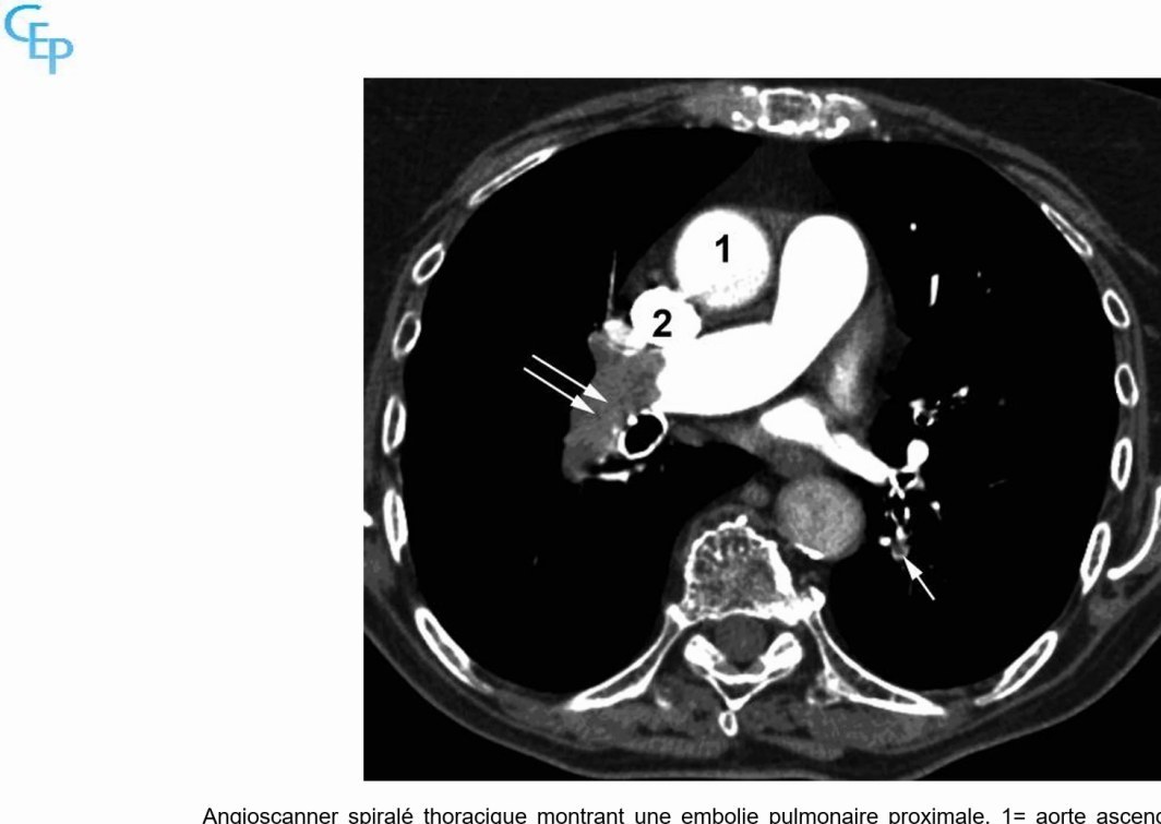 Thrombose Veineuse Profonde et Embolie Pulmonaire