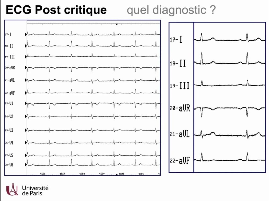 Troubles du Rythme Ventriculaire et Mort Subite