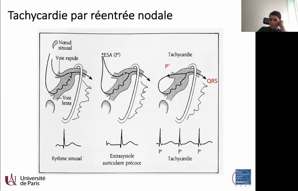 Troubles du Rythme Ventriculaire et Mort Subite