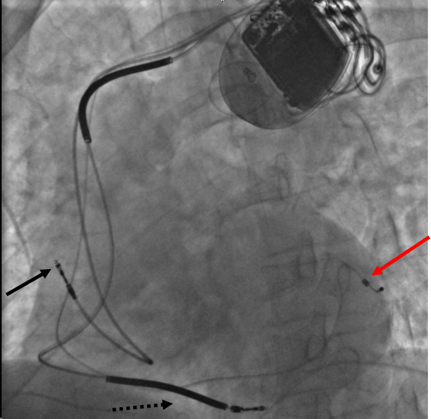 Resynchronisation cardiaque (CRT)
