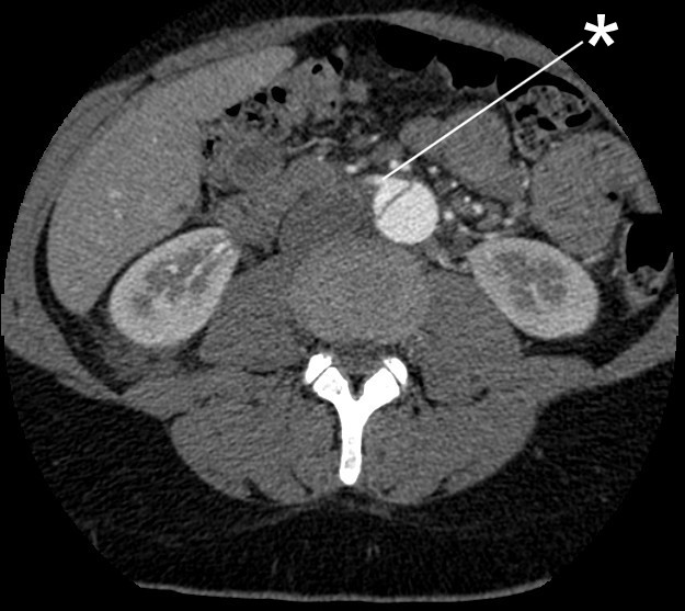 Dissection aortique