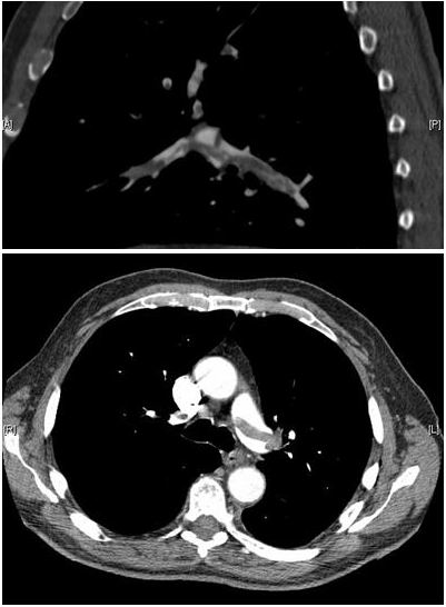 Embolie pulmonaire
