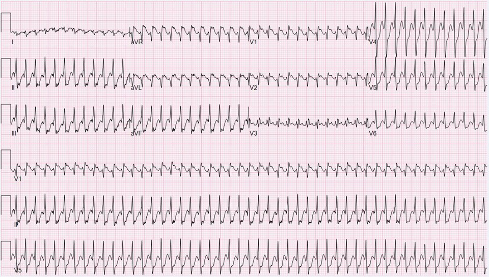 Flutter atrial