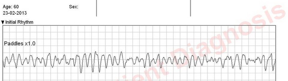 Fibrillation ventriculaire