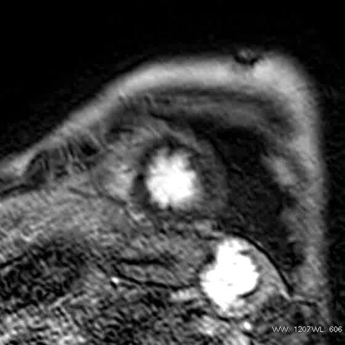 IRM cardiaque — rehaussement tardif